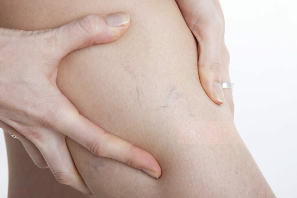 Gestione sintomi lipedema